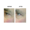 MicroPen before and after