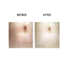 MicroPen before and after