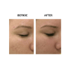 MicroPen before and after