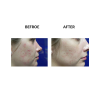 MicroPen before and after