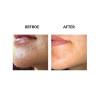 MicroPen before and after