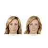 JUVÉDERM® Ultra XC (2 options) NOBD
