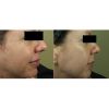 MicroPen before and after