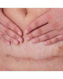 Medical Visit for Acne/Acne Scarring, Eczema, Moles, Rosacea, Skin tags, Skin Cancer Screening