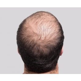 PRP for Hair Loss | Dallas Associated Dermatologists PRP for Hair Loss | Dallas Associated Dermatologists