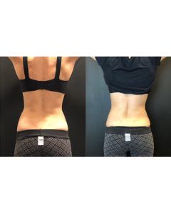 CoolSculpting B&A