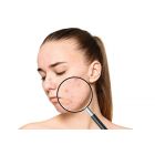 ACNE PROGRAM
