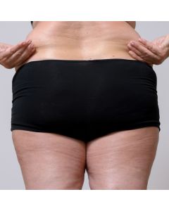 Lower Body Lift Surgery Washington DC