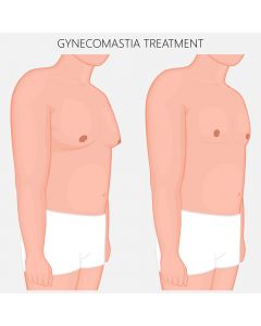 Male Breast Reduction Surgery or Gynecomastia Washington DC