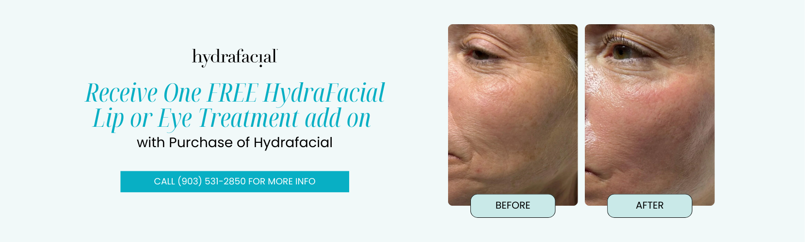 Receive One FREE HydraFacial Lip or Eye Treatment add on with Purchase of Hydrafacial ($100 Value)
