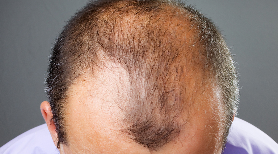 Hair Loss (Alopecia) - Skin Conditions - Medical Dermatology