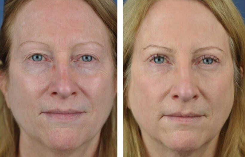 Blepharoplasty