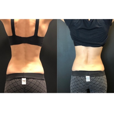 CoolSculpting®