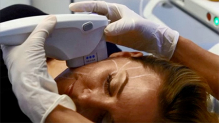 Ultherapy Treatment