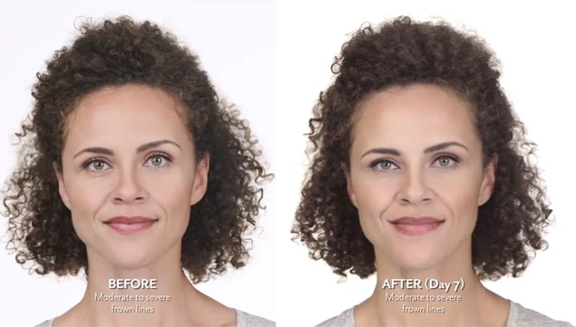 Botox Before and After