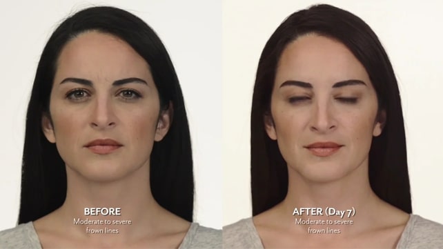 Botox Before and After