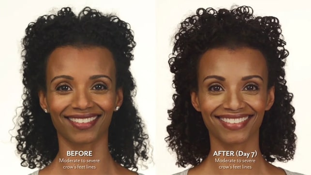 Botox Before and After