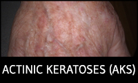 Actinic Keratoses (AKs)