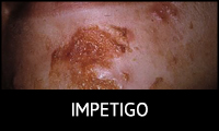 Impetigo
