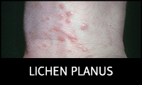 Lichen Planus