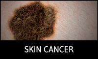 Skin Cancer Topics