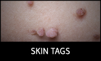 Skin Tags