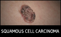 Squamous Cell Carcinoma