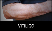 Vitiligo