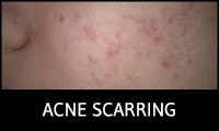 Acne Scarring