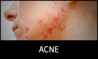 Acne