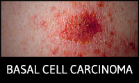Basal Cell Carcinoma