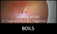 Boils