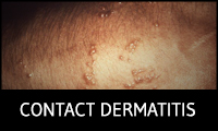 Contact Dermatitis