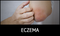 Eczema