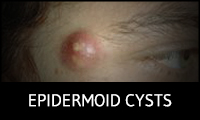 Epidermoid Cysts