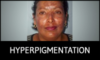 Hyperpigmentation