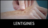Lentigines