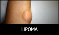 Lipomas