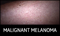 Malignant Melanoma
