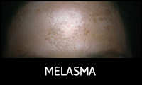 Melasma