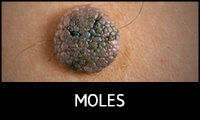 Moles