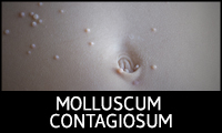 Molluscum Contagiosum