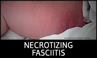 Necrotizing Fasciitis