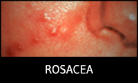 Rosacea