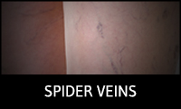 Spider Veins