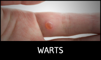 Warts