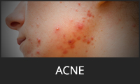 Acne