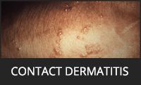 Contact Dermatitis