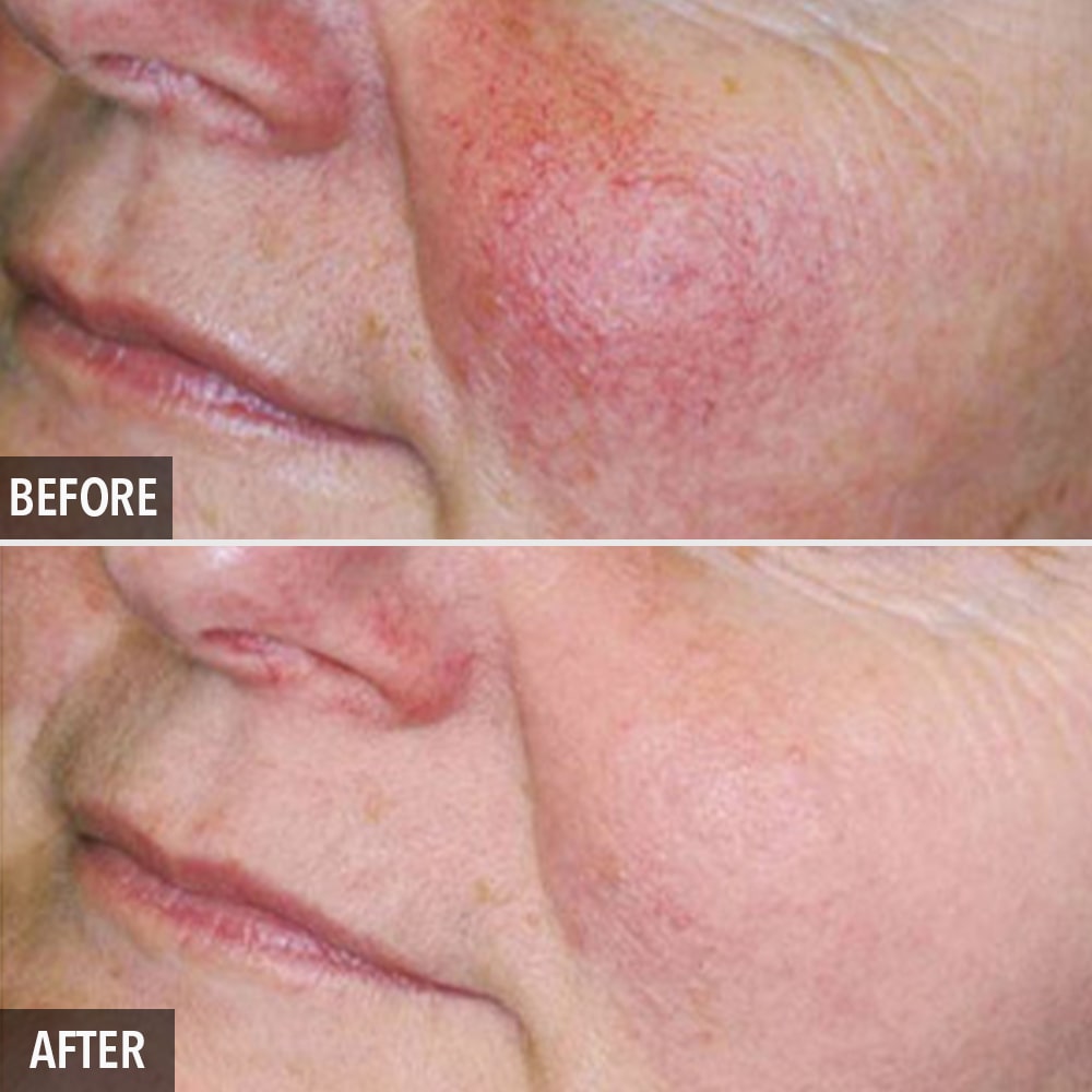photorejuvenation before and after