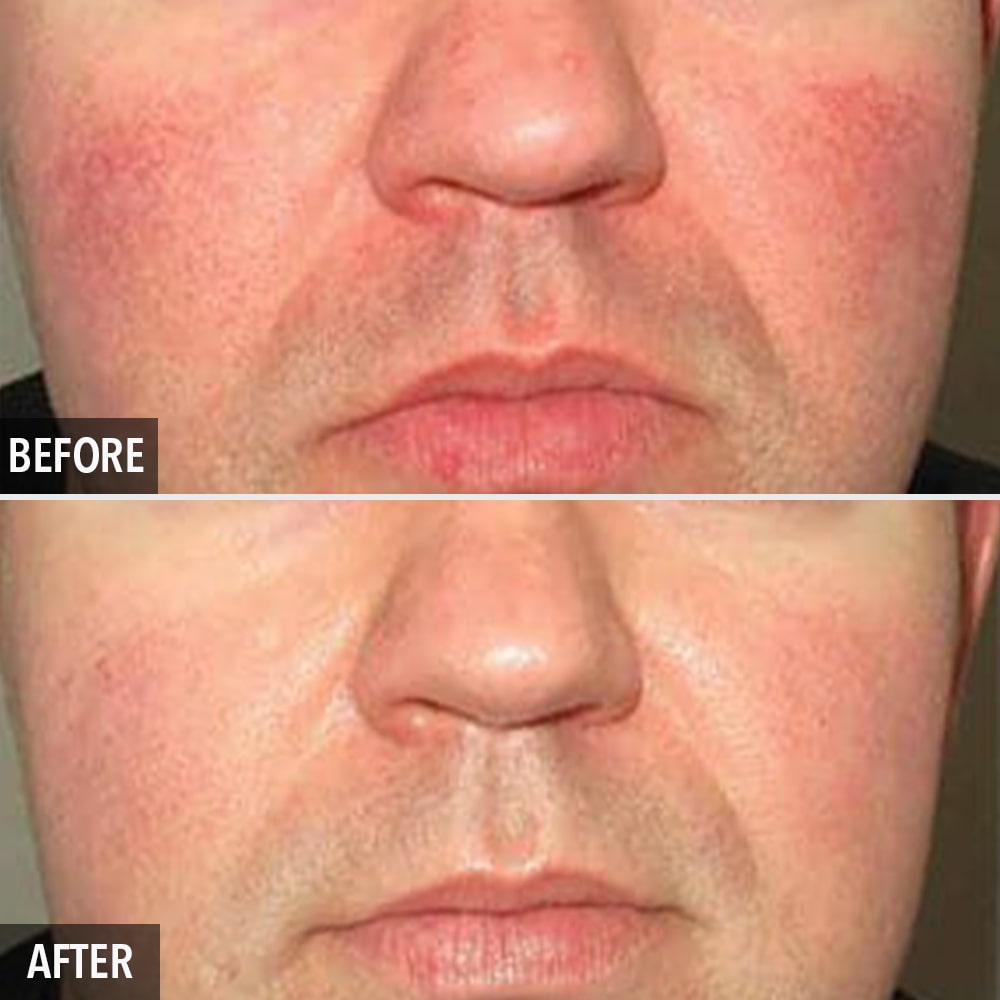 photorejuvenation before and after
